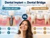 Dental Implant vs. Dental Bridge: Which Tooth Replacement Option Is Right for You?