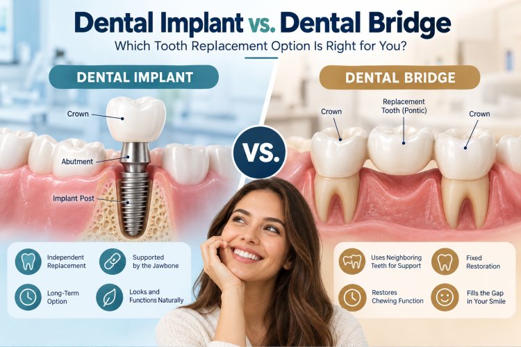 Dental Implant vs. Dental Bridge: Which Tooth Replacement Option Is Right for You?