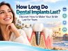 How Long Do Dental Implants Last? Discover How to Make Your Smile Last for Years